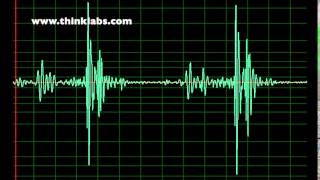 Right Bundle Branch Block slow [upl. by Zoldi291]