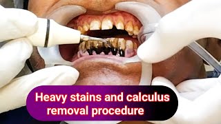 Heavy stains and calculus removal  Deep teeth cleaning treatment  drhirenpatelvlo [upl. by Ariec]