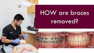 HOW are braces removed  Dr Jiten Vadukul  The Orthodontist [upl. by Ruy]