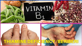 BeriBeri  Thiamine deficiency [upl. by Schultz840]