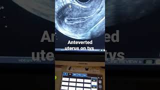 what is Anteverted uterus and how its looks on tvs ultrasound [upl. by Bellis]