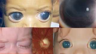 PRIMARY CONGENITAL GLAUCOMA  buphthalmos megalocornea haabs striae cupping and more [upl. by Oiragelo377]