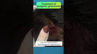 Treatment of pyogenic granuloma  By Dr Uttam Kumar Lenka MBBS MD Consultant Dermatologist [upl. by Eymaj]