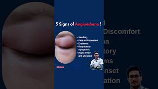 Angioedema [upl. by Ibbie398]