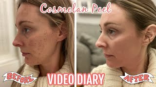 THE COSMELAN PEEL  MY FIRST CHEMICAL PEEL  DIARY FROM APPLICATION TO DAY 30 [upl. by Eelram56]