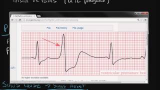 Electrocardiography Cardiac Arrhythmias [upl. by Enaamuj]