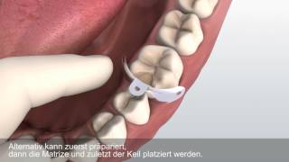 Das V3 Matrizensystem von Triodent [upl. by Vinnie]