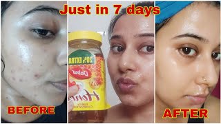 7 days Challenge Remove Pimple Marks amp Acne Scars Naturally at Home  पिंपल्स के दाग हटाने के उपाय [upl. by Carla652]