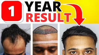 Case Study Hair Transplant Result After 1 Year 🔥 [upl. by Antony494]