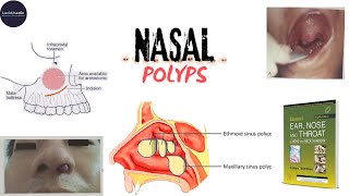 NASAL POLYPANTROCHOANALETHMOIDALETIOLOGYSSTREATMENT dhingra otorhinolaryngology udaipurwala [upl. by Adnima557]