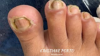 🤤 VÍDEO MAIS PEDIDO DO CANAL… RETIRADA DE PELE NO PÉ TODO nails satisfatório ingrowntoenail [upl. by Fredra]