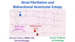 Atrial Fibrillation and Bidirectional Ventricular Ectopy [upl. by Fradin597]