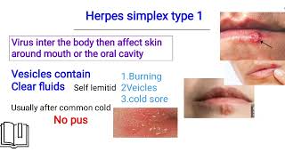 herpes simplex infection الهيربس [upl. by Zischke]