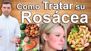 Adiós a la Rosacea  Remedios Caseros Y Cremas Para Combatir Y Curar las Manchas en la Cara Y Piel [upl. by Ssalguod]