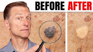 How to Remove Skin Tags and Warts Overnight  Dr Berg Explains [upl. by Fancy880]