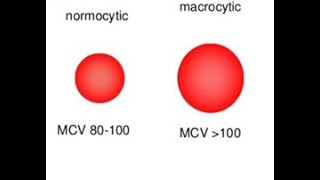 Anemia macrocítica [upl. by Elletnwahs338]