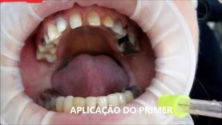 REABILITAÇÃO ESTÉTICA EM CERÂMICA  CIMENTAÇÃO [upl. by Kirtap971]