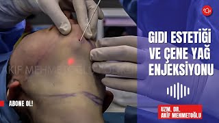 NECK LASER LİPOSUCTİON AND CHİN FAT İNJECTİON  GIDI ESTETİĞİ VE ÇENE YAĞ ENJEKSİYONU [upl. by Anse]