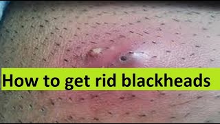 How to get rid blackheads Permanently [upl. by Howey957]