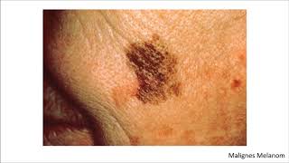 Dermatologie Blickdiagnosen  Krankheitsbilder [upl. by Narayan]