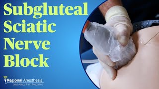 Subgluteal Sciatic Nerve Block [upl. by Nirraj526]