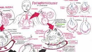 Emphysema  Pathophysiology COPD [upl. by Cotter312]