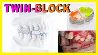 ♦️TWIN BLOCK♦️ Aparato dental para NIÑOS para corregir HIPOPLASIA MANDIBULAR [upl. by Jer252]