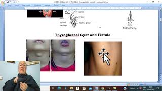 Head and neck surgery in Arabic 3  Thyroglossal cyst   by Dr Wahdan [upl. by Yeliab]