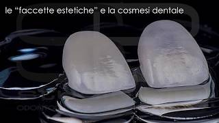 Faccette Dentali Estetiche e Cosmesi Dentale  Studio Bini [upl. by Siclari]