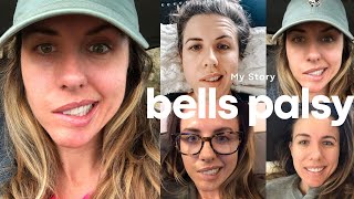 My Bells Palsy Sotry Recovery Story amp My Signs and Symptoms [upl. by Margit]