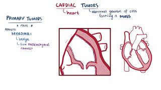 Cardiac tumors Myxoma Rhabdomyoma causes symptoms amp pathology [upl. by Auqinu827]