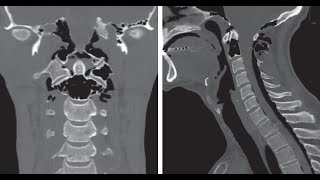 Idiopathische kraniozervikale Hyperpneumatisation mit Pneumorrhachis [upl. by Ellehcsor]