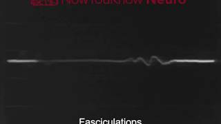 EMG Fasciculations [upl. by Reidar]