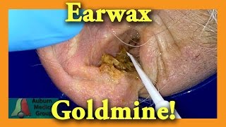 Earwax GOLDMINE  Auburn Medical Group [upl. by Einaled]