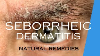 TREAT SEBORRHEIC DERMATITIS with NATURAL REMEDIES [upl. by Ganley]