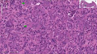 Giant Cell Tumor  Bone Histopathology [upl. by Adnorehs494]