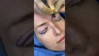 Upper Blepharoplasty for Hooded Upper Eyelids  Dr Kami Parsa  Droopy Eyelids [upl. by Aicella577]