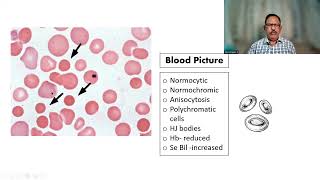 OMG EXAM 8 Spherocytosis Dr GSS SRM MCH RC [upl. by Arihsay]