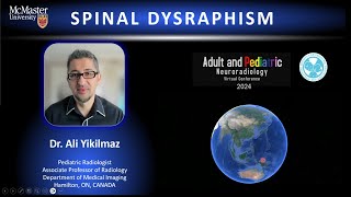 Spinal Dysraphism  brief [upl. by Alleirbag]