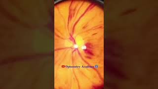 Diabetic retinopathy  Hemorrhages  proliferative diabetic retinopathy PDR  Short Video 184 [upl. by Pesek]