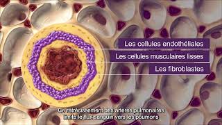 Qu’estce que l’hypertension artérielle pulmonaire  HTAP [upl. by Neely]