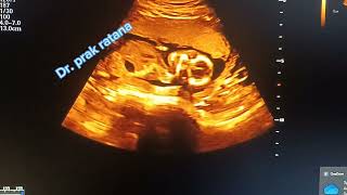 Pregnancy from first to last trimester by ultrasound scan subscribe for more video [upl. by Alaik439]