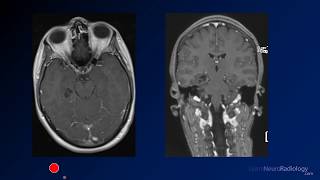 Neuroradiology board review 2 case 8 [upl. by Marta]