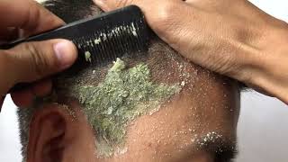 GET RID of Those HUGE Dandruff Flakes [upl. by Ogir]