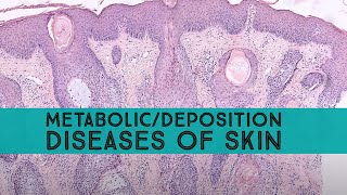 MetabolicDeposition Diseases of Skin amp Mimics Board Review for Dermpath Dermatology Pathology [upl. by Anyk]