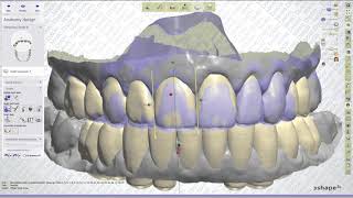 3Shape Traditional Diagnostic Waxup from Trios Scan [upl. by Pandolfi]