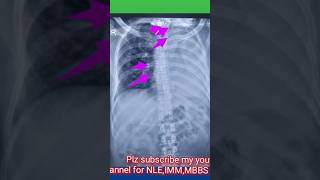 4 signs of lung collapse on chest xray  4 causes of lung collapse on chest xraychestxraymbbs [upl. by Meghan]