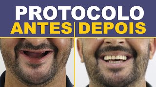 8 Casos de Implantes Protocolo  Antes e Depois [upl. by Greene]