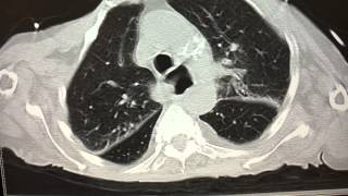 very abnormal CXR followed with CT scan of the chest [upl. by Jarlath]