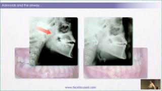 The Case for Rewards of Correcting Rest Oral Posture  William M Hang DDS MSD [upl. by Bumgardner]